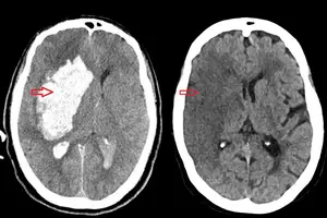 À esquerda, tomografia computadorizada de crânio evidenciando AVC hemorrágico; e à direita, tomografia computadorizada de crânio evidenciando AVC isquêmico (Foto: Reprodução | Neurolink)