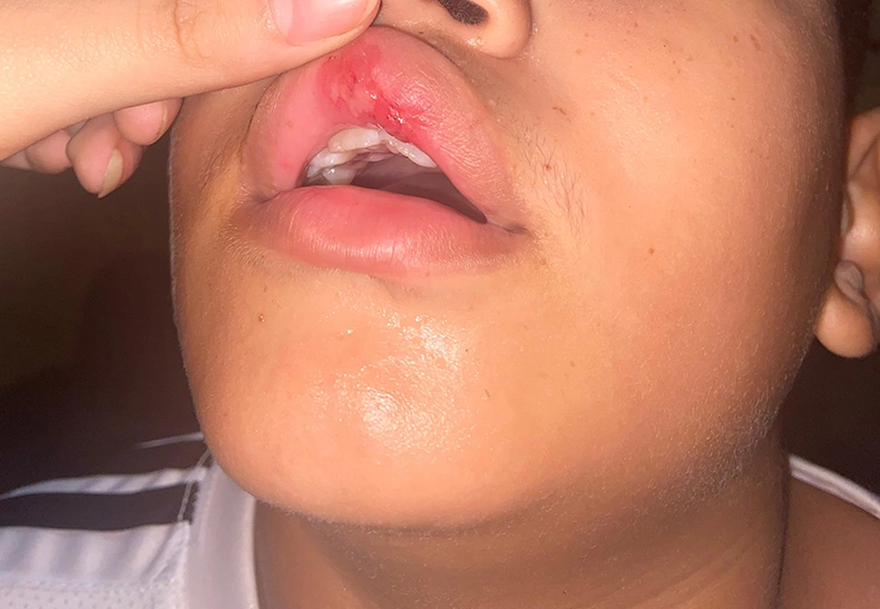 Ferimentos na mucosa da boca que teria sido provocado pelas agressões