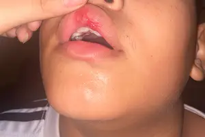 Ferimentos na mucosa da boca que teria sido provocado pelas agressões (Foto: Reprodução)