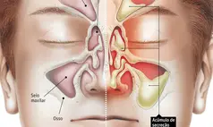 Saiba como diferenciar gripe, resfriado, rinite e sinusite durante o inverno