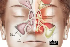 Na sinusite, o muco fica acumulado nos seios da face (Foto: Reprodução)