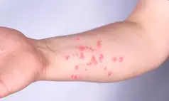 Brasil contabiliza 88 casos confirmados de mpox em 2026