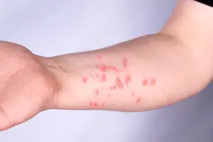 Mpox (Foto: Reprodução | Getty Images)