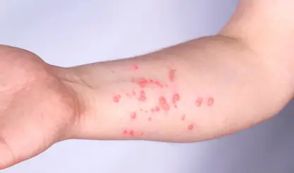 Brasil contabiliza 140 casos confirmados de mpox em 2026